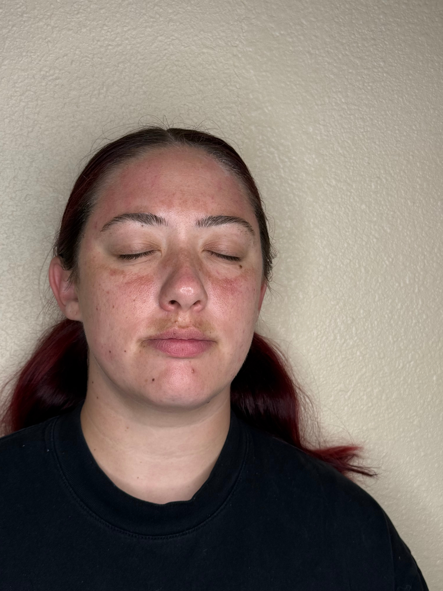IPL Photofacial After