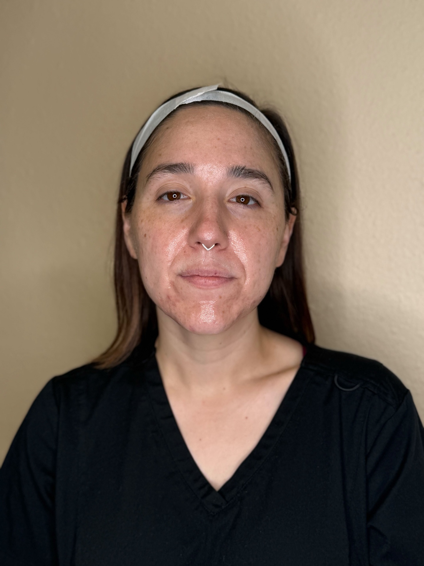 Vivace RF Microneedling Before
