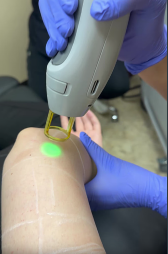 Laser Hair Removal Before
