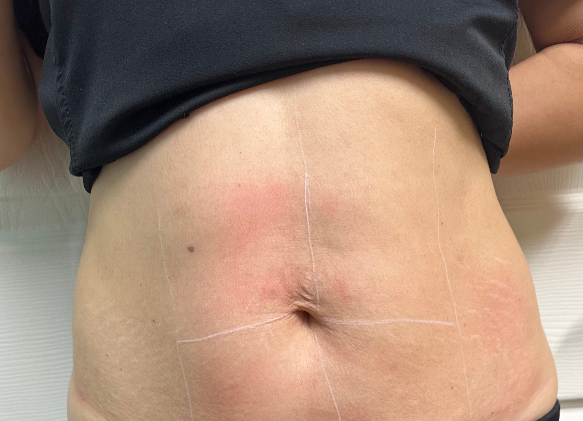 Laser Skin Tightening After