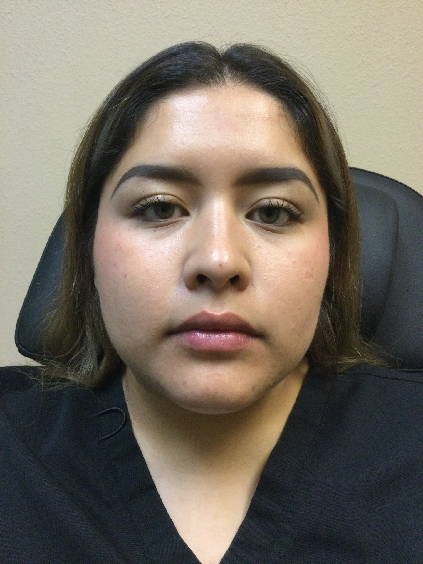Botox Lip Flip After