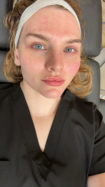 Vivace RF Microneedling After
