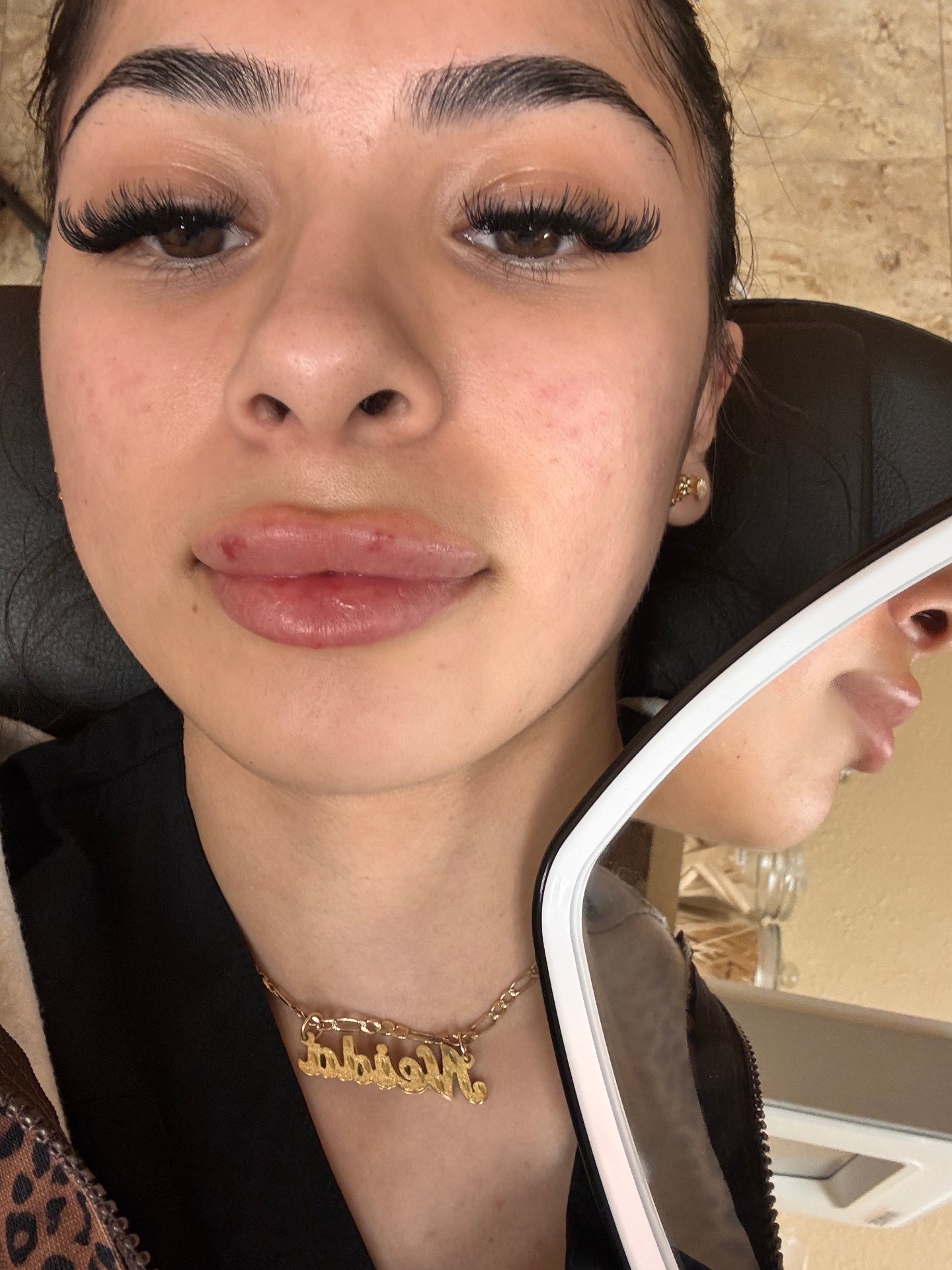 Vivace RF Microneedling After