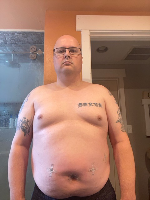 Medical Weight Loss Before