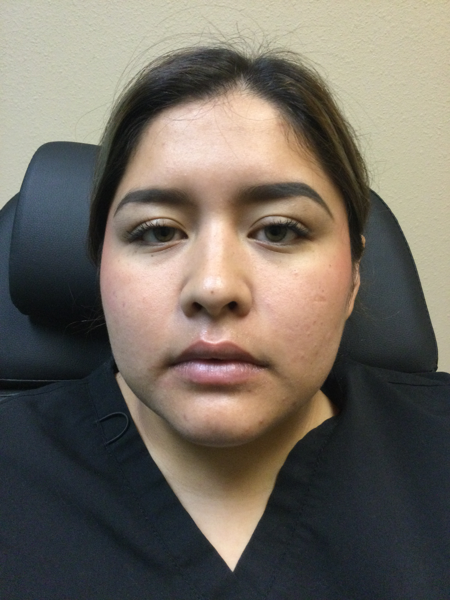 Botox Lip Flip Before