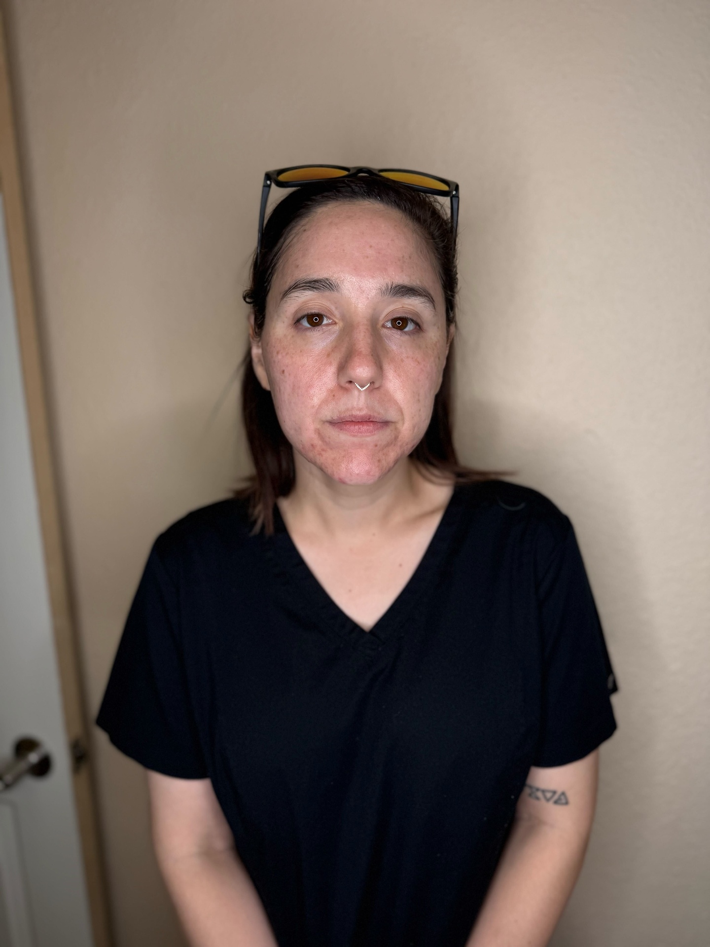 Vivace RF Microneedling After