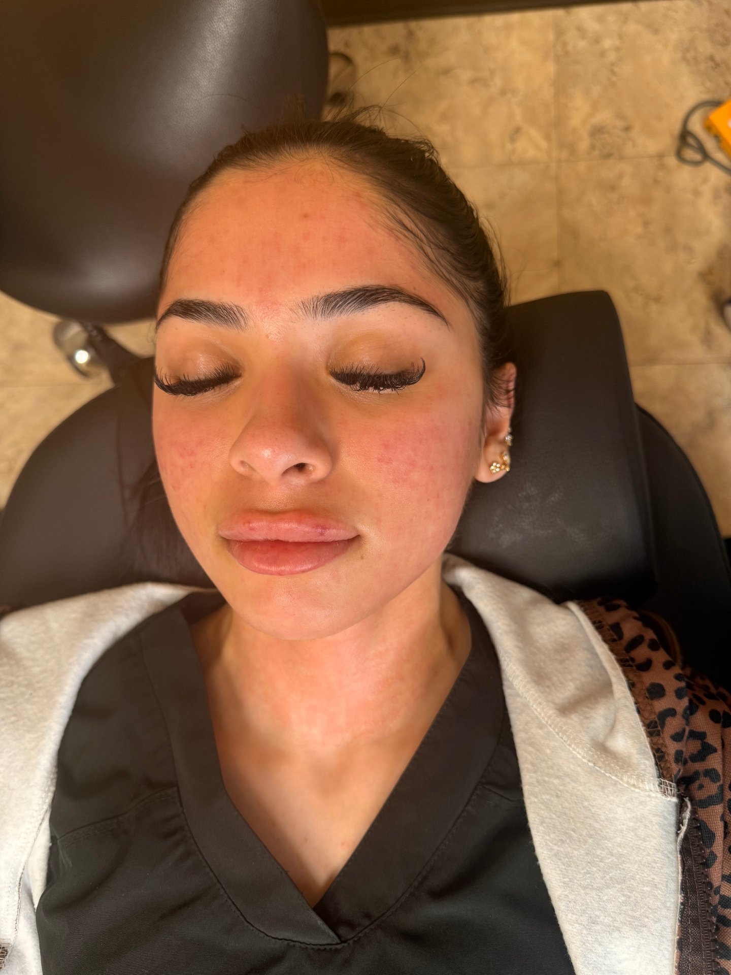 Vivace RF Microneedling Before