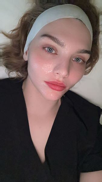 Vivace RF Microneedling Before