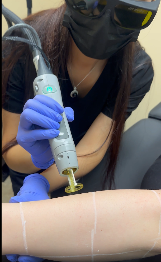 Laser Hair Removal After