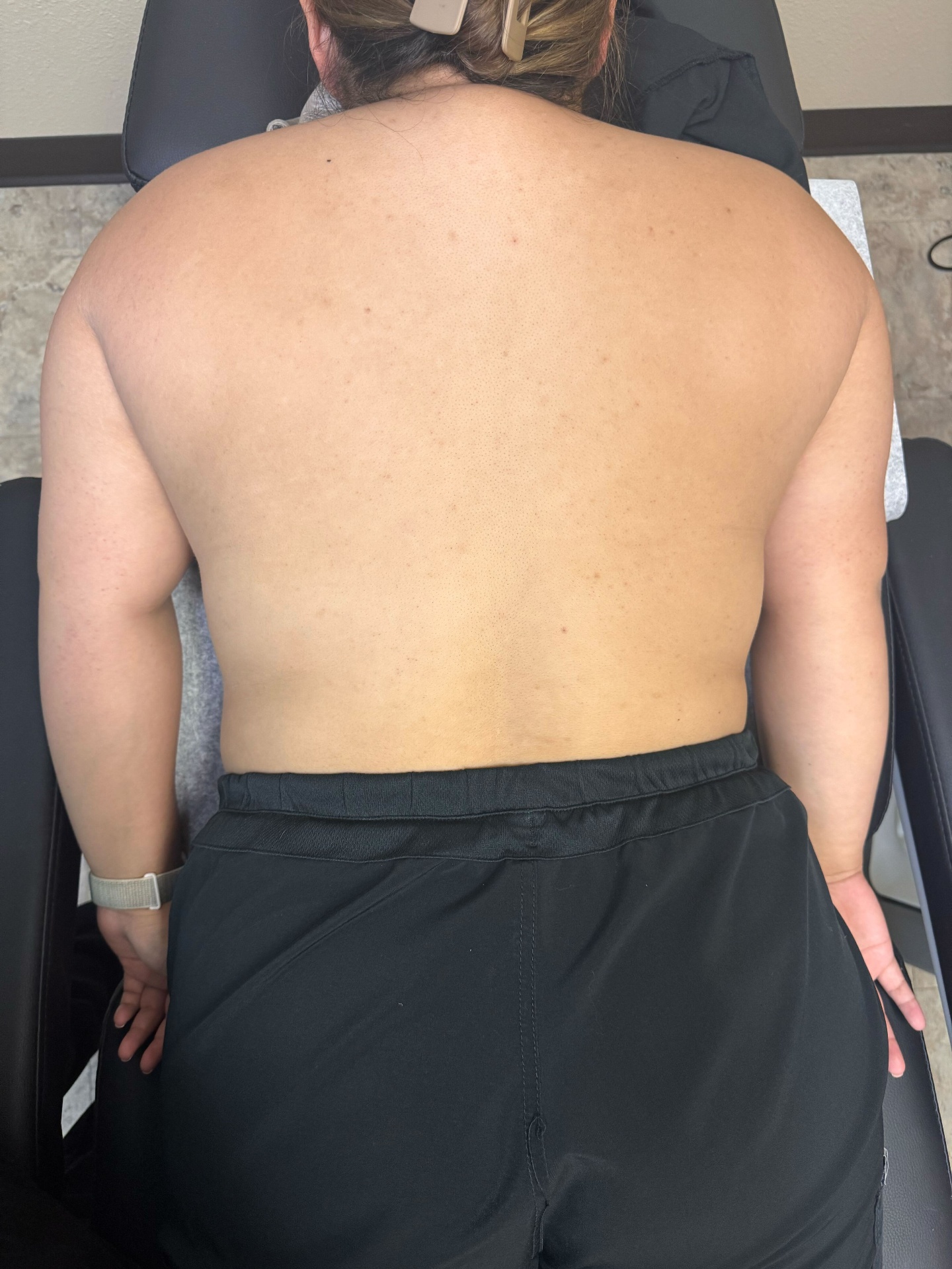 Laser Skin Tightening Before