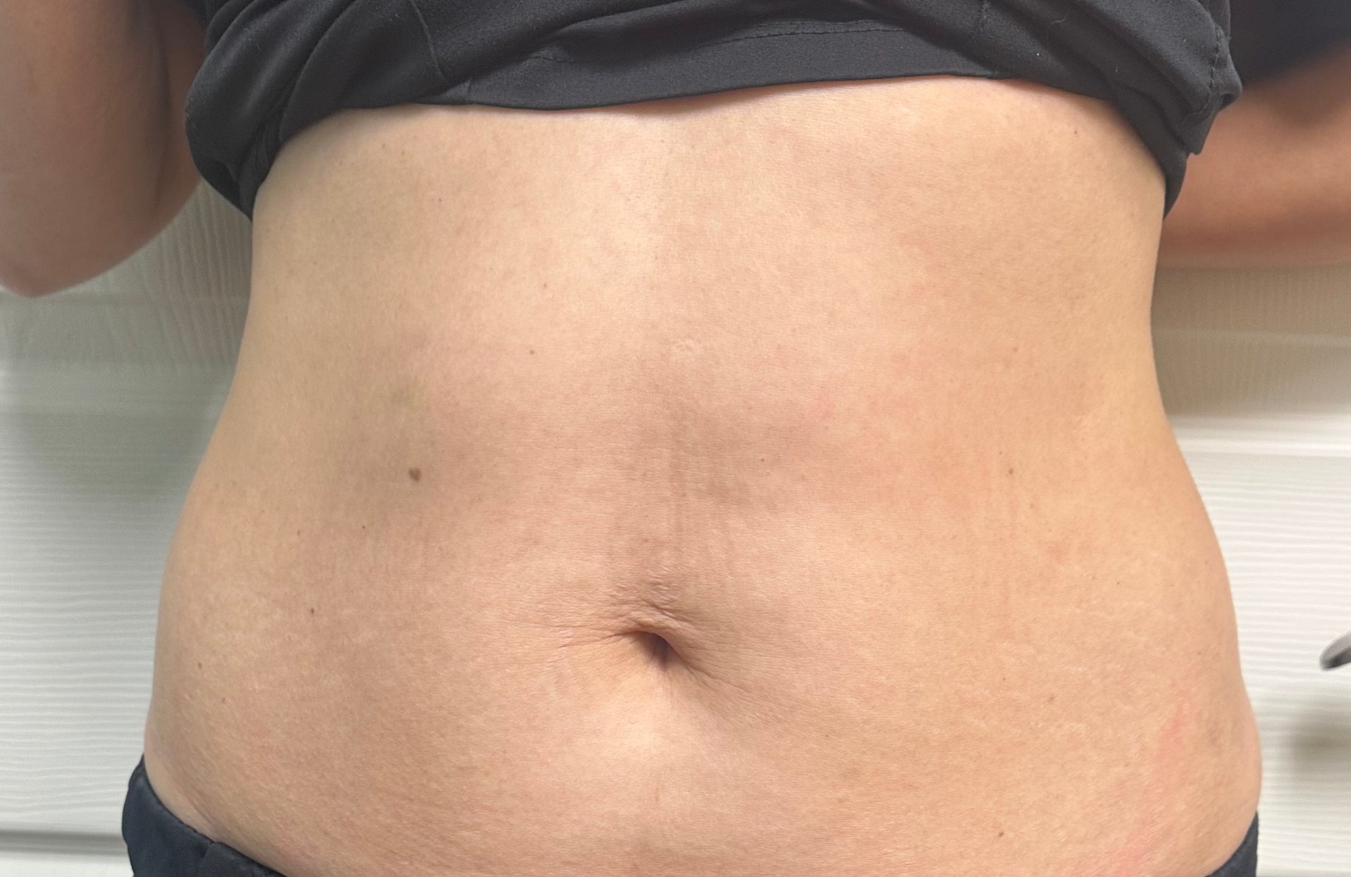 Laser Skin Tightening Before