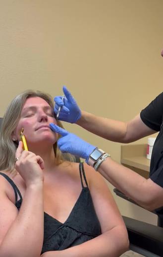 Botox Lip Flip Before