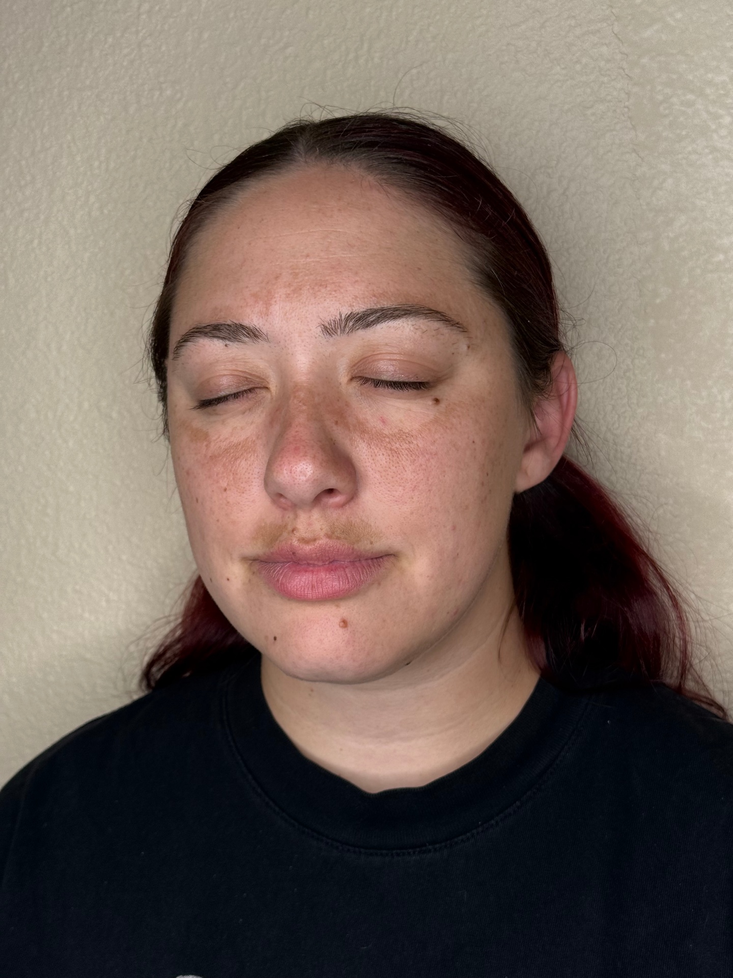 IPL Photofacial Before