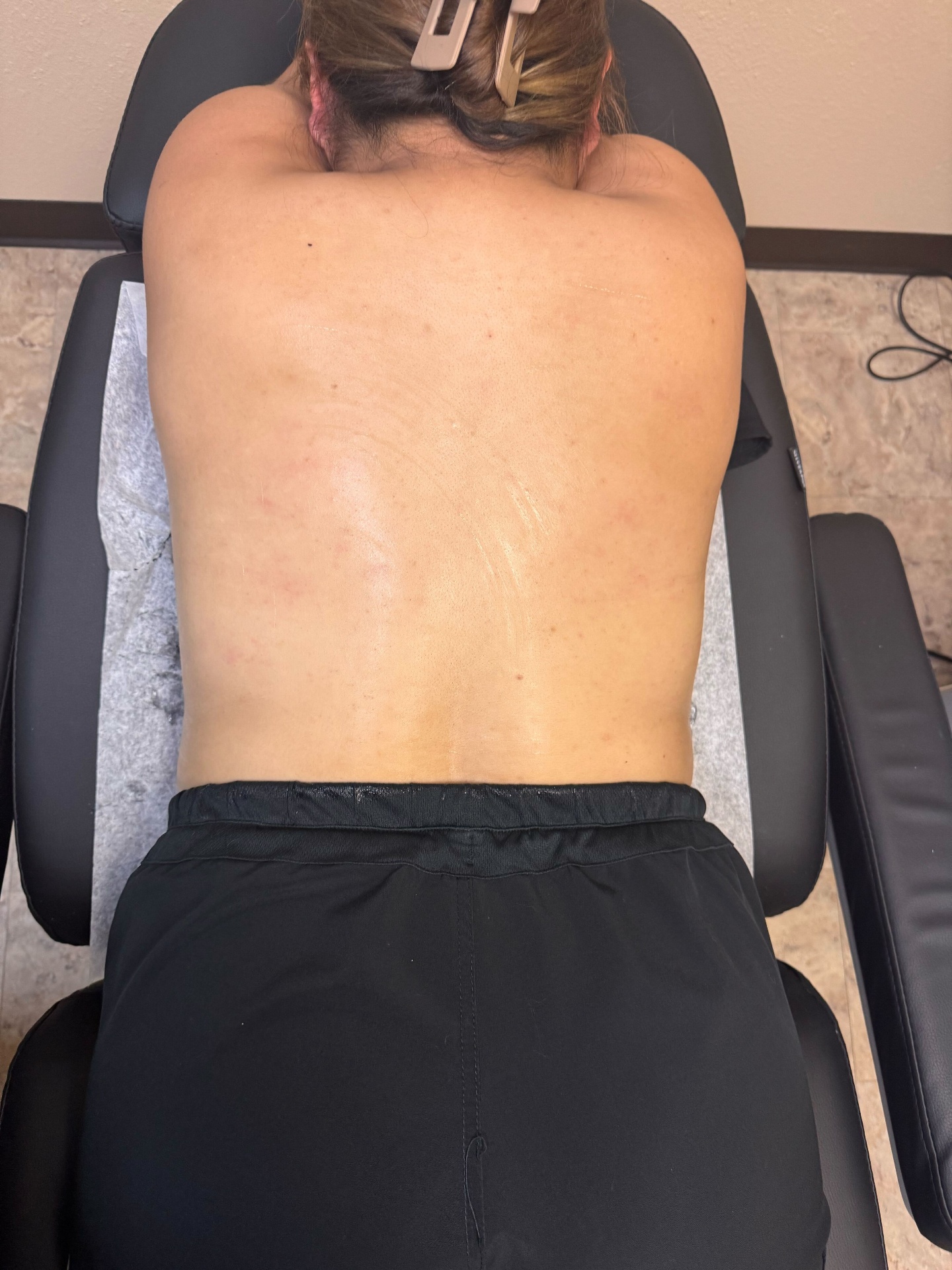 Laser Skin Tightening After