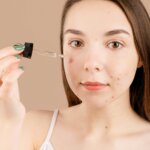 Breakthrough Acne Scar Treatment | Allen MedSpa