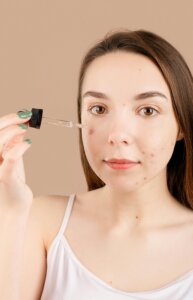 acne scar treatment