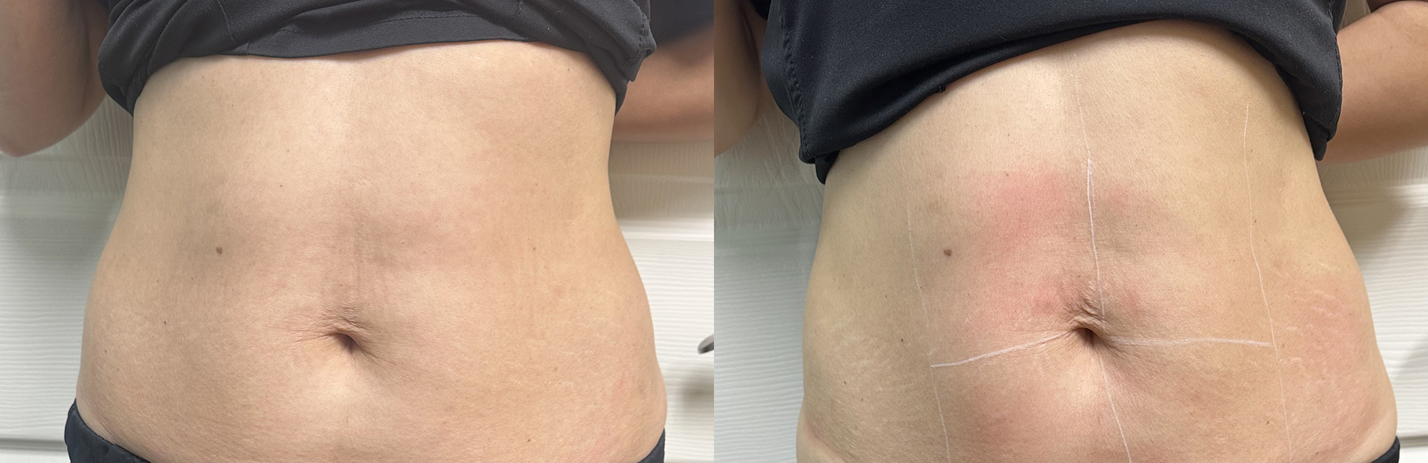 Before and After Image: Laser Skin Tightening - front