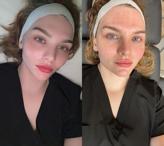 Before and After Image: Vivace - front