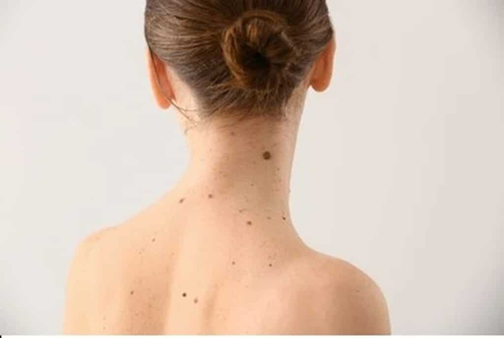 young_woman_moles_high_quality_1920px A mole on the back of a woman's neck