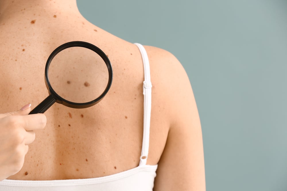 A doctor looking a moles on a woman's back before a DermaSensor skin cancer screening
